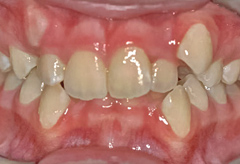 Malposition dentaire