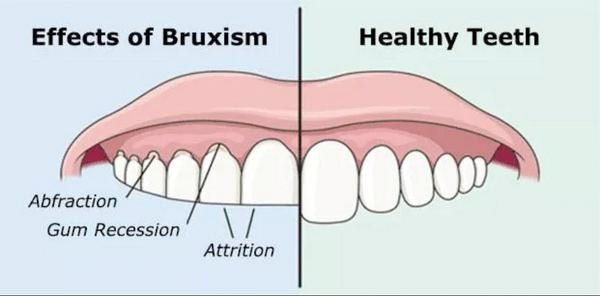 Effects of bruxism