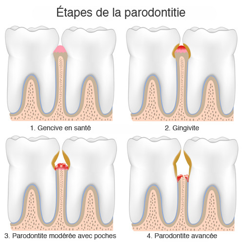 Étapes de la parodontite