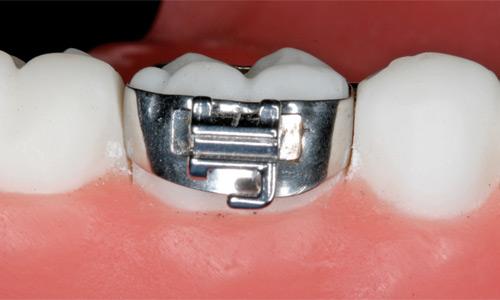 Orthodontic band