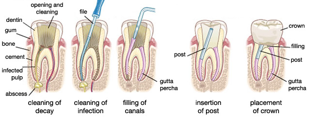 Root canal treatment step by step