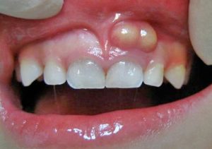 Abscess from front baby teeth