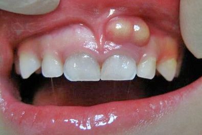 Comment éviter un abcès dentaire?