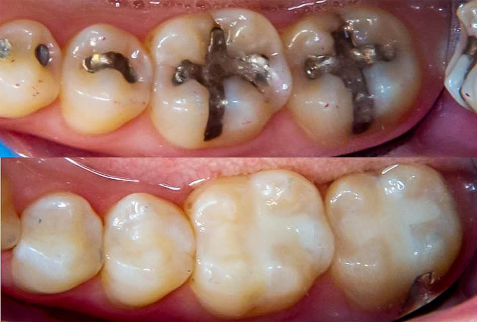 What lasts longer, grey or white fillings?