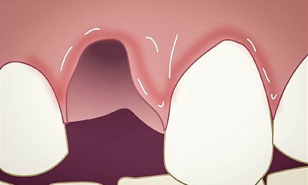 Avulsion dentaire: que faire lorsqu’une dent tombe suite à un accident