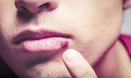 Cold sore (herpes labialis)