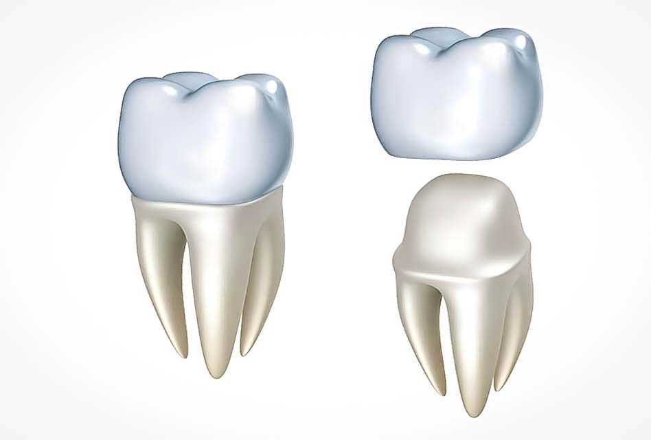 Is it necessary to place a dental crown on a tooth that had a root canal?