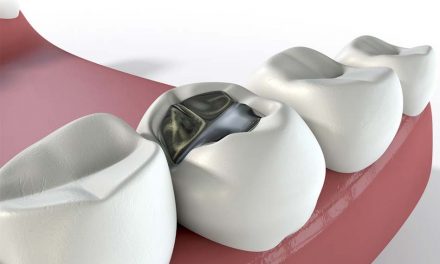 Dental fillings