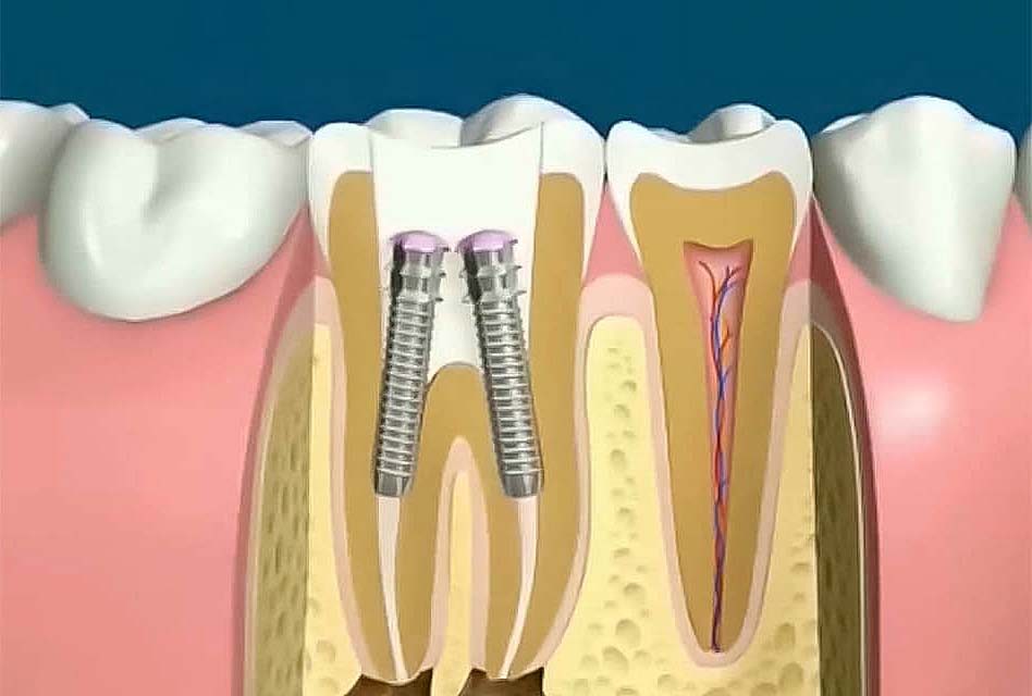Pivot dentaire