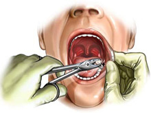 Schéma d'extraction dentaire