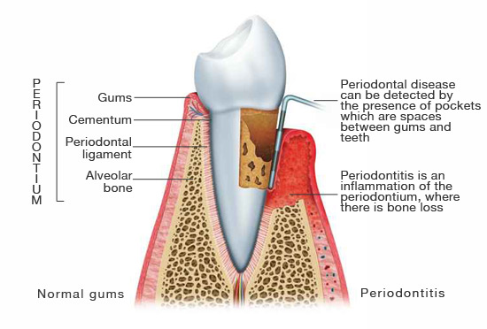Parodontite