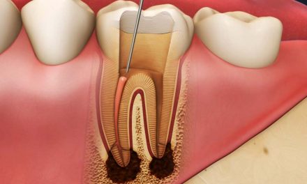 Retraitement endodontique