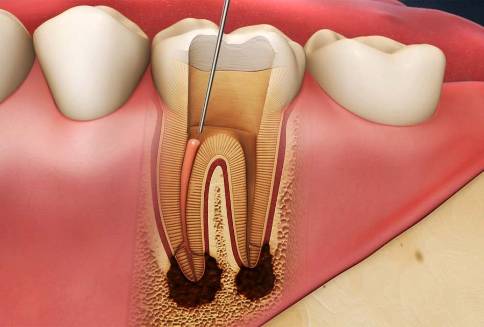 Endodontic retreatment