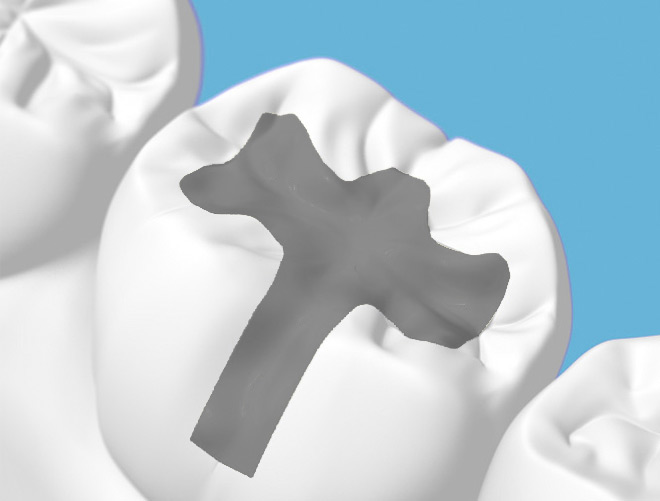What are the advantages of silver fillings?