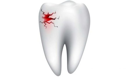 Can an abscess cause a tooth to break apart?
