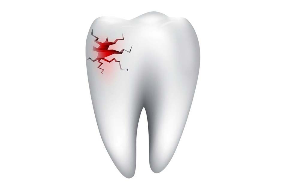 Can an abscess cause a tooth to break apart?