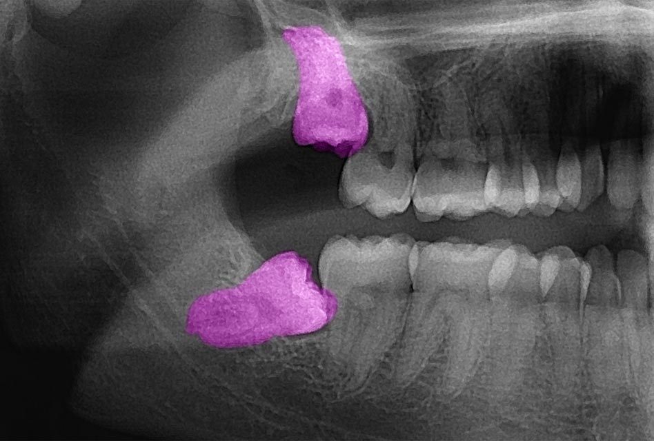 Impacted tooth (tooth impaction)