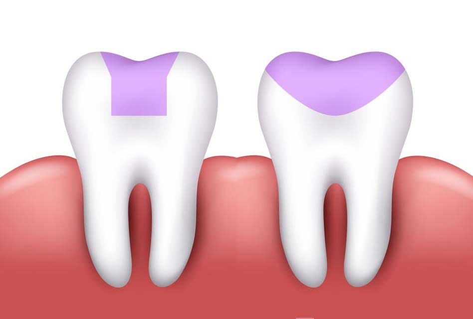 Inscrustation dentaire (inlay et onlay)