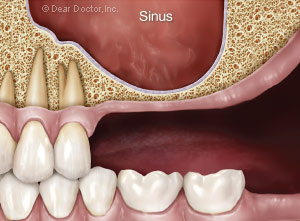 Sinus lift | Studio Dentaire