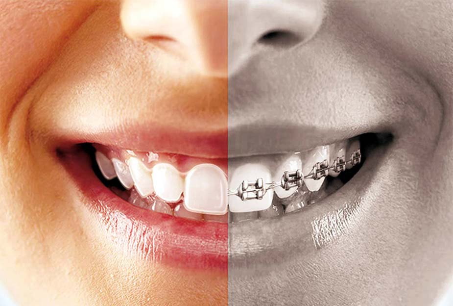 Invisible orthodontics