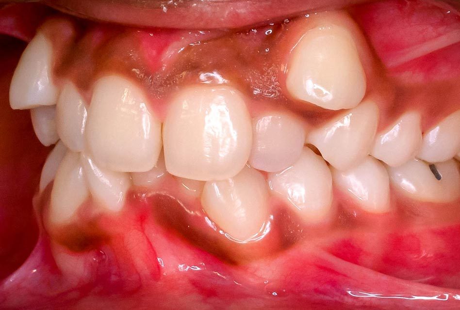 Malocclusion (Misaligned Teeth)