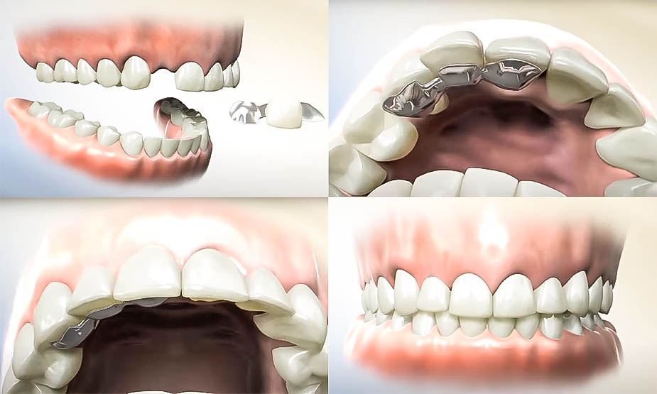 Maryland bridge to replace missing lateral incisor