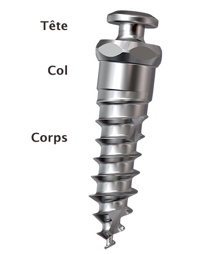 Anatomie d'un mini-implant