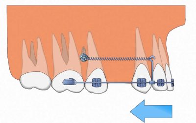 Mini-implants or mini-screws for orthodontics