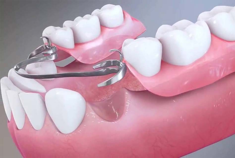 Prothèse amovible (dentier et partiel)