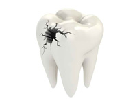 Root canal kills a tooth?