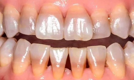 Will taking antibiotics make the colour of your teeth darker?