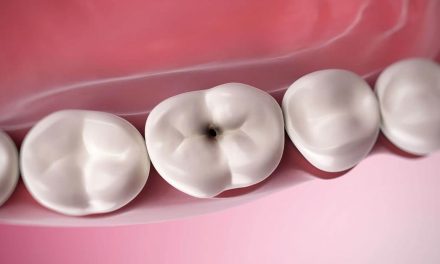 What may happen if you don’t treat a cavity?