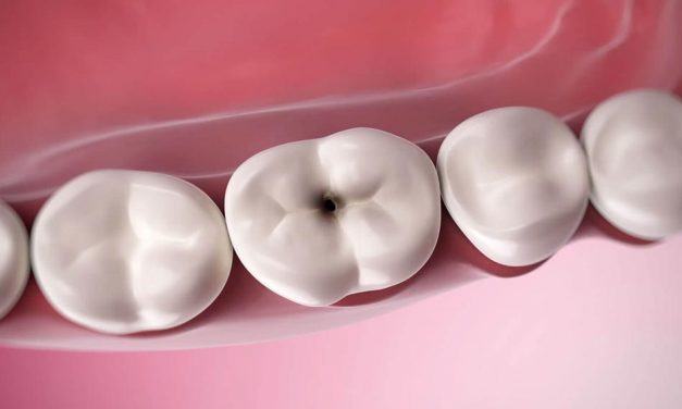 What may happen if you don’t treat a cavity?