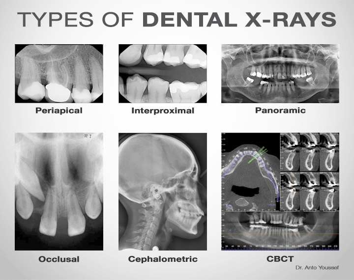 Types of dental x-rays