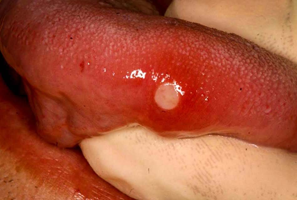 How can you get rid of an ulcer or a canker sore on your tongue?