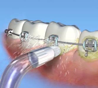 Waterpik orthodontic tip