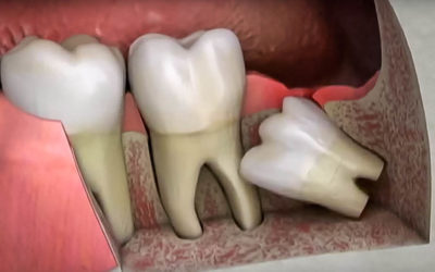 5 things you didn’t know about wisdom teeth