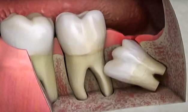 5 choses que vous ne saviez pas sur les dents de sagesse