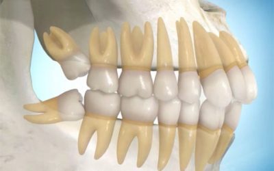 Can wisdom teeth move other teeth?