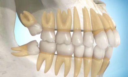 Can wisdom teeth move other teeth?