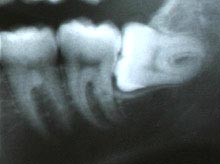 X-ray of a Wisdom Tooth